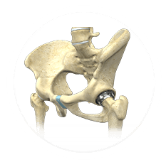 Hip Arthroscopy